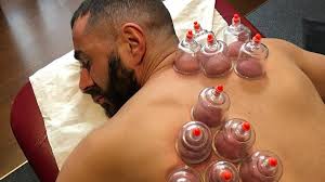 Séance de Hijama pour détoxification et soulagement du corps